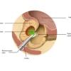 Calculaser-Procedimientos-Cirugia-de-prostata