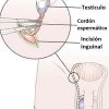 ORQUIECTOMIA_RADICAL