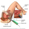 ds00043_-my00182_im02640_hdg7_prostatebiopsythu_jpg