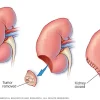 my01181_im04375_mcdc7_partial_nephrectomythu_jpg