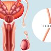 vasectomia_procedimiento